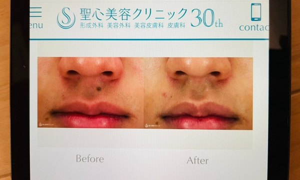 聖心美容クリニック ほくろ除去症例