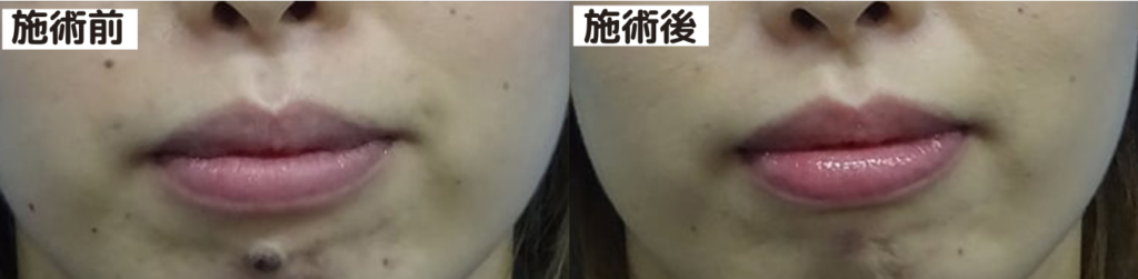 TCB東京中央美容外科 ほくろ除去症例