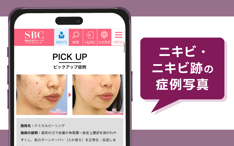 湘南美容クリニックのニキビ・ニキビ跡の症例