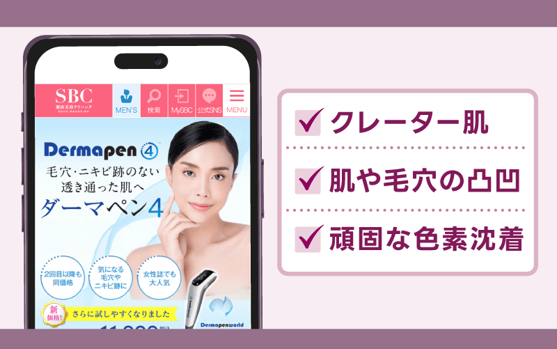 クレーターのニキビ跡にはダーマペンがおすすめ