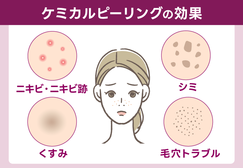 湘南美容クリニックのケミカルピーリングは何に効果的?口コミ人気はニキビ治療