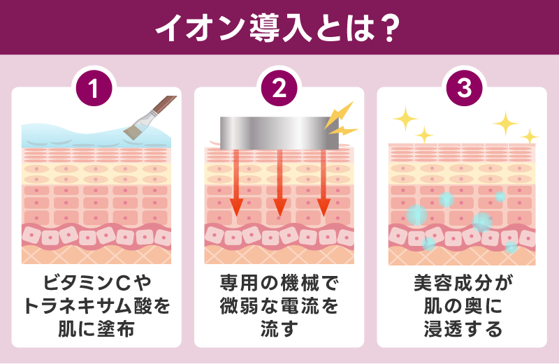 イオン導入とは?