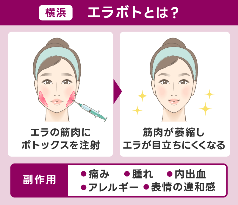 横浜エラボトックス