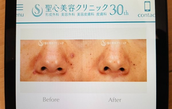 聖心美容クリニック ほくろ除去症例