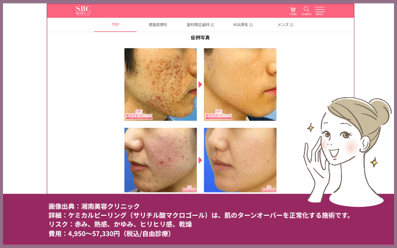 湘南美容クリニックのケミカルピーリング