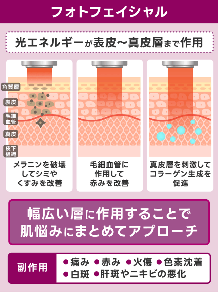 フォトフェイシャルとは